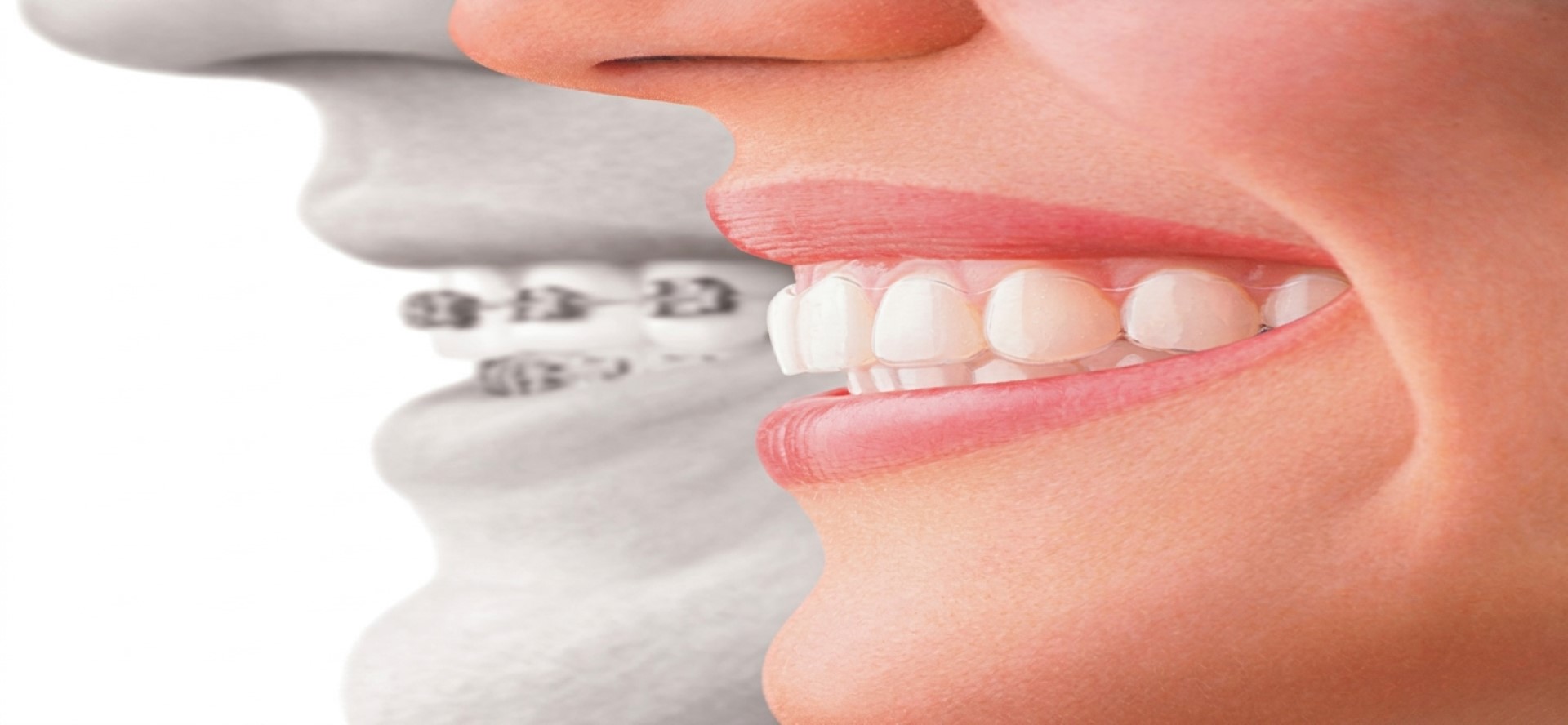 Bartın Invisalign şeffaf plak ve ortodonti tedavisi